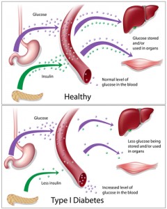 What is Type1 Diabetes